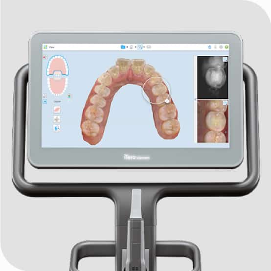 Invisalign - Digitalorthoteam Srbija