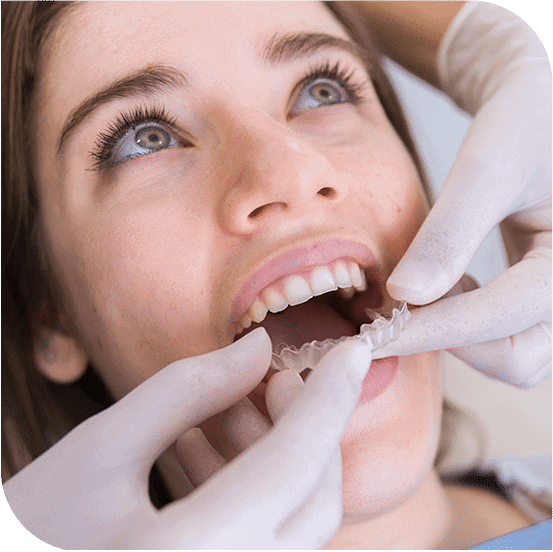 Invisalign folije za ispravljanje zuba