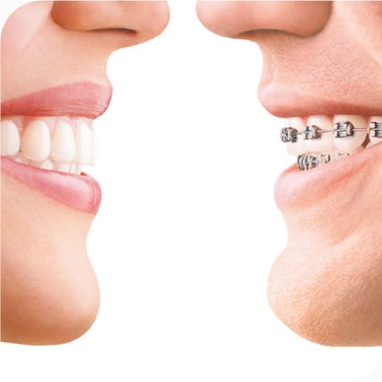 Invisalign folije za ispravljanje zuba